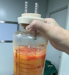 重庆水动力吸脂手术要做多久？